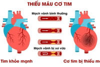 Thiếu Máu Cơ Tim Là Bệnh Gì? Tìm Hiểu Nguyên Nhân, Triệu Chứng Và Cách ... Best Wearable Technology For Fitness Enthusiasts